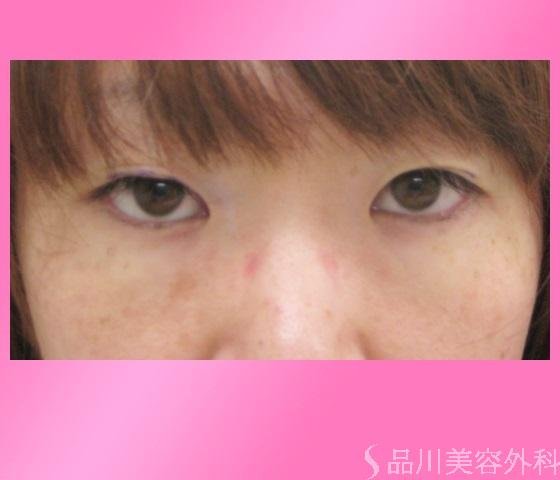 症例NO.13900のBEFORE写真