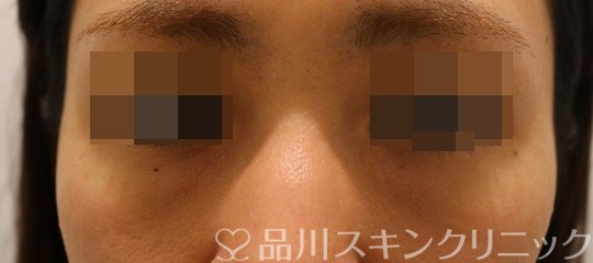 症例NO.68537のBEFORE写真