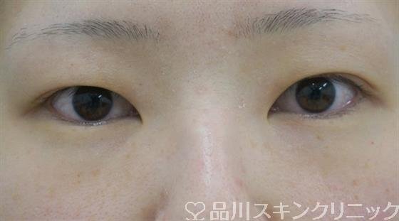 症例NO.40210のBEFORE写真