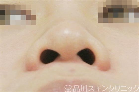 症例NO.38264のBEFORE写真