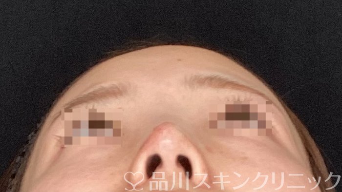 症例NO.64649のAFTER写真