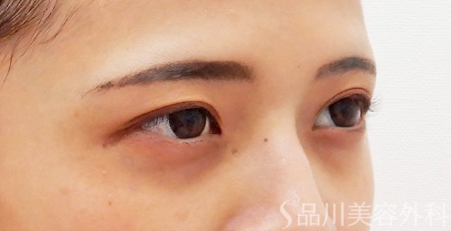 症例NO.62350のBEFORE写真