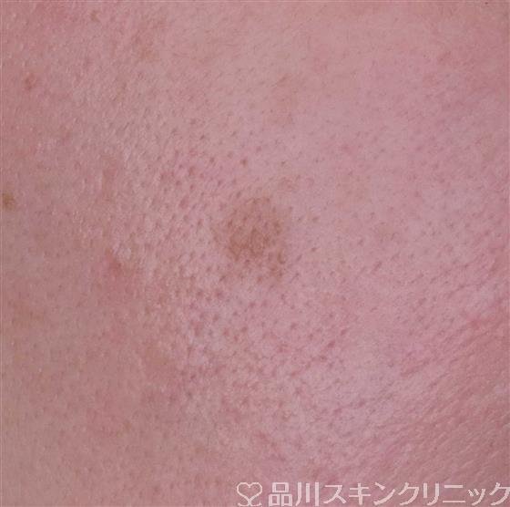 症例NO.60609のBEFORE写真