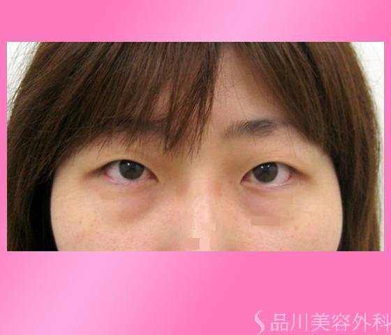 症例NO.2877のBEFORE写真