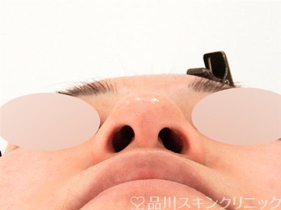 症例NO.59394のBEFORE写真