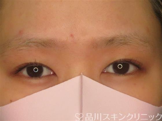 症例NO.60240のBEFORE写真