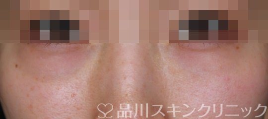 症例NO.64424のBEFORE写真