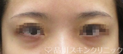 症例NO.67051のBEFORE写真