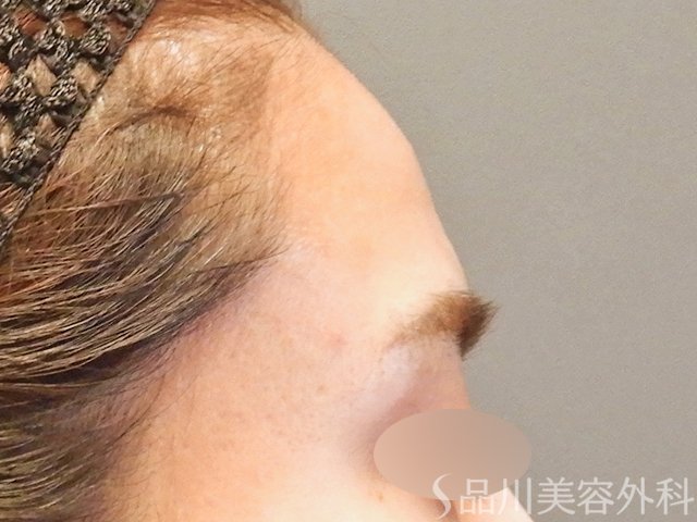 症例NO.65739のBEFORE写真