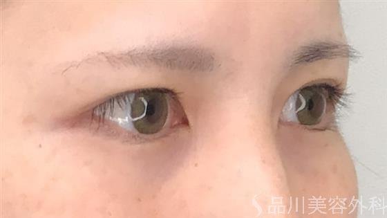 症例NO.59628のBEFORE写真