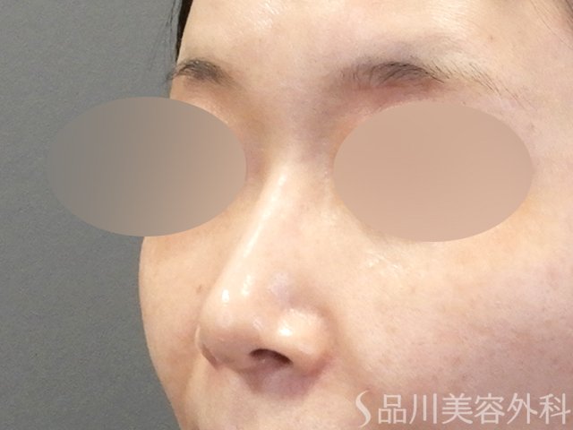 症例NO.68927のBEFORE写真