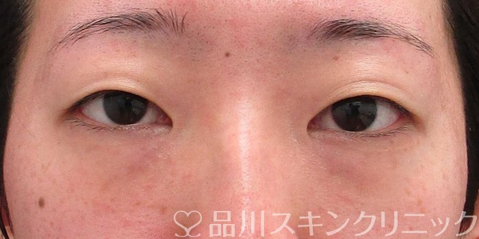 症例NO.66616のBEFORE写真