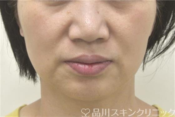 症例NO.30869のBEFORE写真