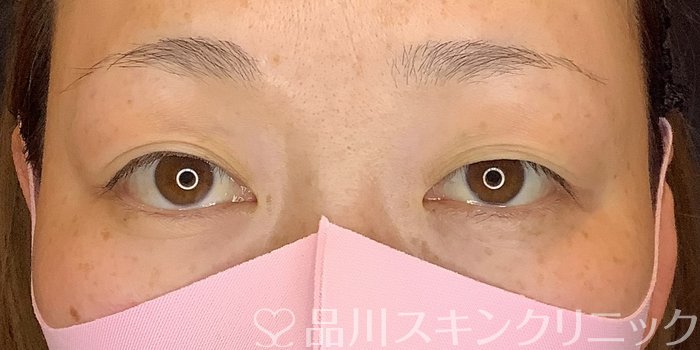 症例NO.68974のBEFORE写真