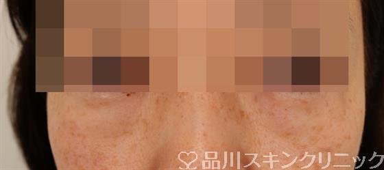 症例NO.50896のBEFORE写真