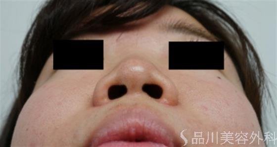 症例NO.26972のBEFORE写真