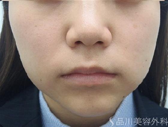 症例NO.15975のBEFORE写真