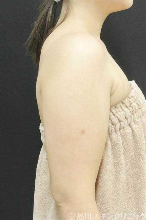 症例NO.43261のBEFORE写真