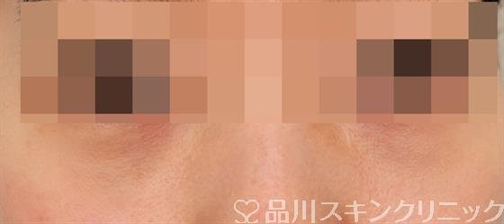 症例NO.49763のAFTER写真