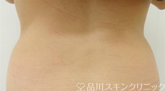 症例NO.32808のBEFORE写真