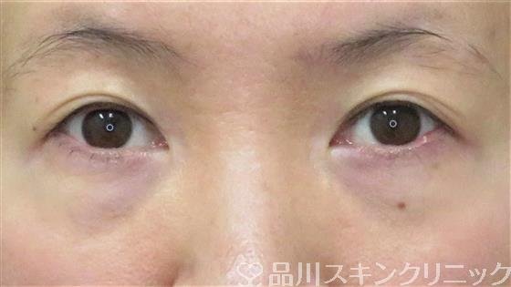 症例NO.61057のBEFORE写真