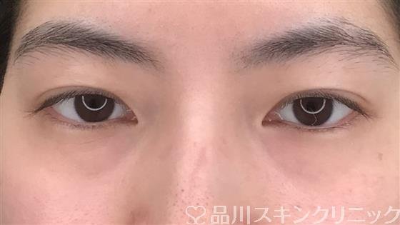 症例NO.55145のBEFORE写真