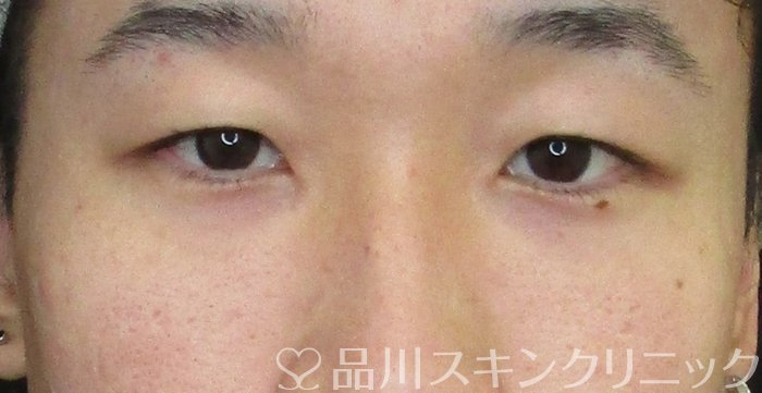 症例NO.68531のBEFORE写真