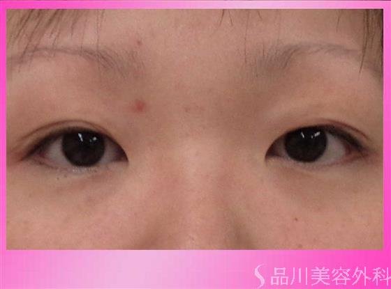 症例NO.40348のBEFORE写真