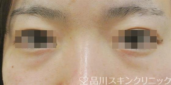 症例NO.32895のBEFORE写真