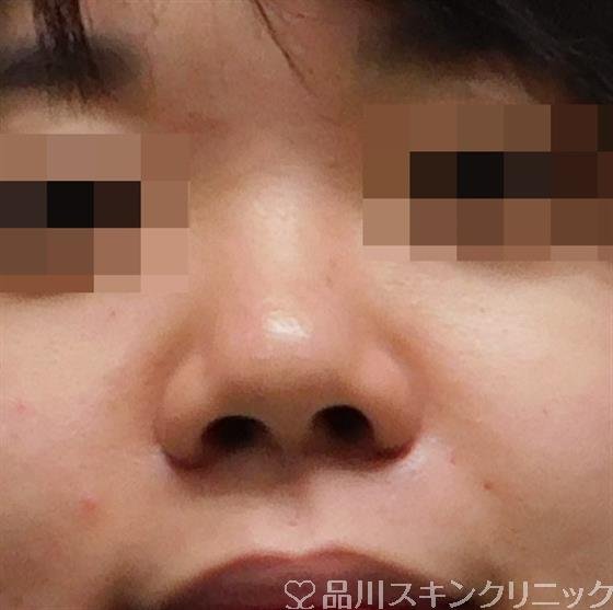 症例NO.49695のBEFORE写真