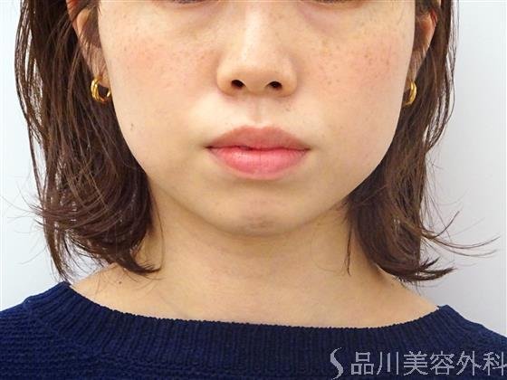 症例NO.45408のBEFORE写真