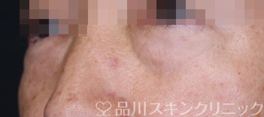 症例NO.64035のBEFORE写真