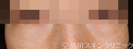 症例NO.52952のBEFORE写真