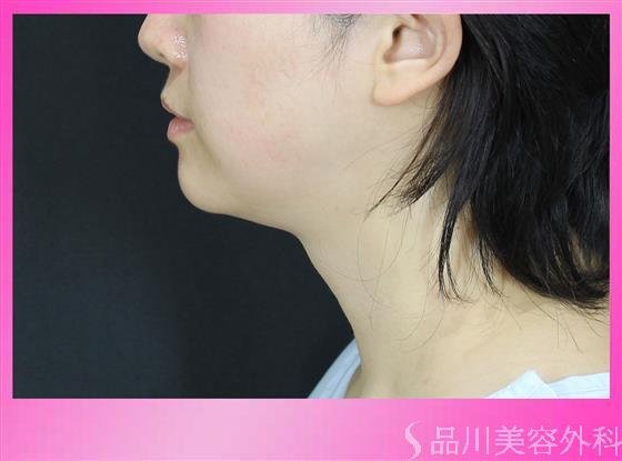 症例NO.51053のBEFORE写真