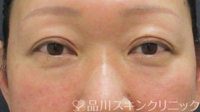 症例NO.69136のBEFORE写真