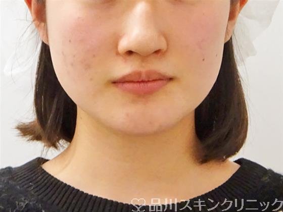 症例NO.50924のBEFORE写真