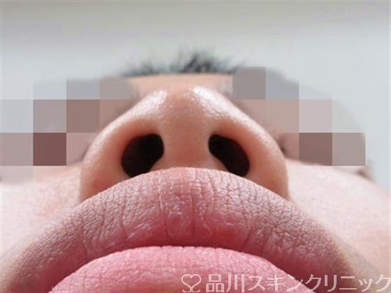 症例NO.31443のBEFORE写真