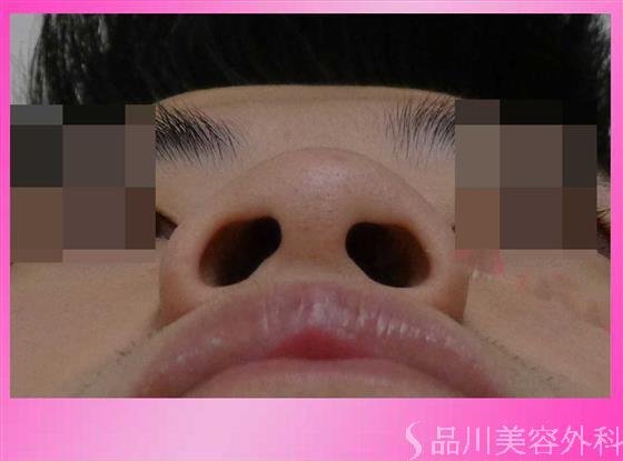 症例NO.33350のBEFORE写真