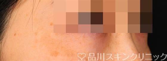 症例NO.53501のBEFORE写真