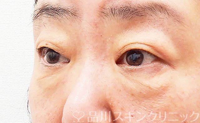 症例NO.62239のBEFORE写真