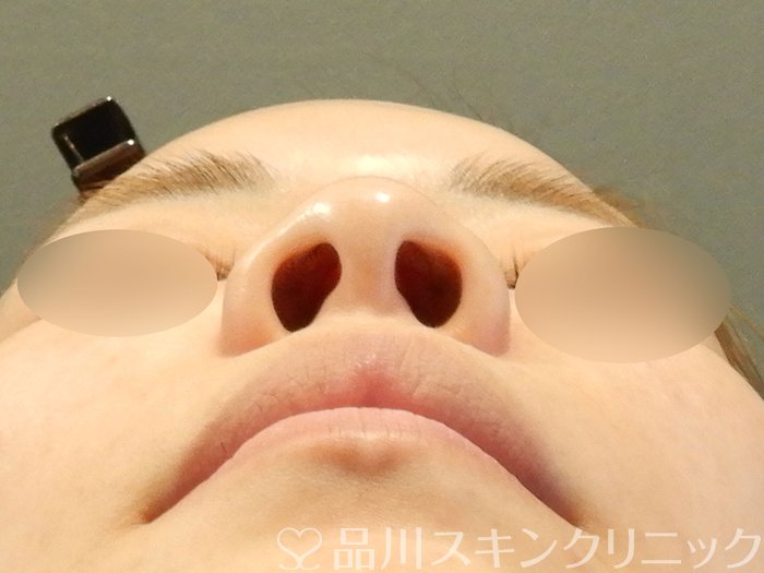 症例NO.67960のBEFORE写真