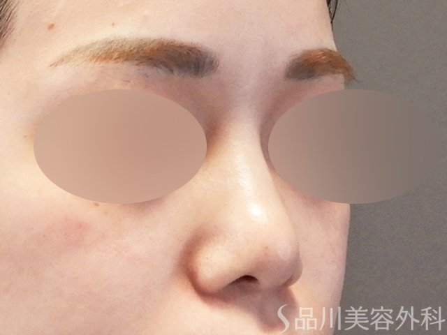 症例NO.66919のBEFORE写真