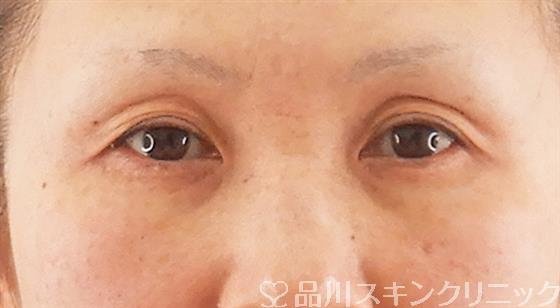 症例NO.58353のBEFORE写真