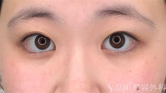 症例NO.56904のBEFORE写真