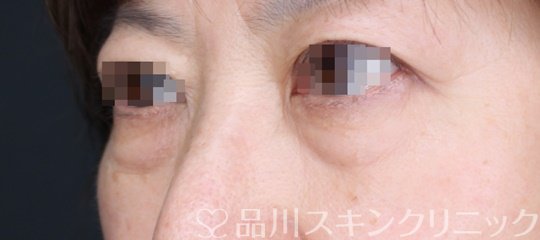 症例NO.65092のBEFORE写真