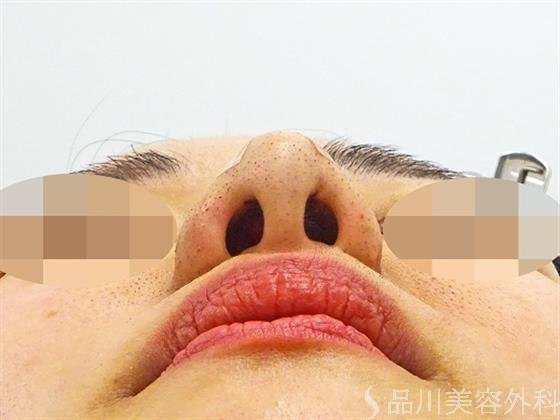 症例NO.46216のAFTER写真