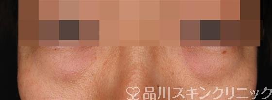 症例NO.54024のBEFORE写真