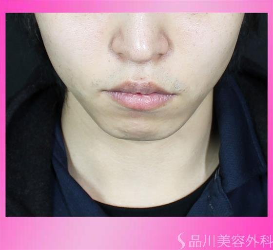 症例NO.54170のBEFORE写真