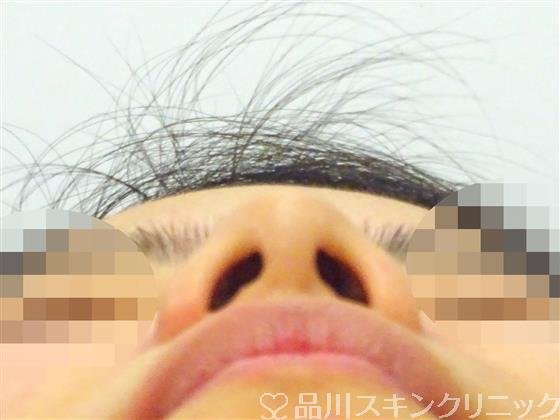 症例NO.45091のBEFORE写真