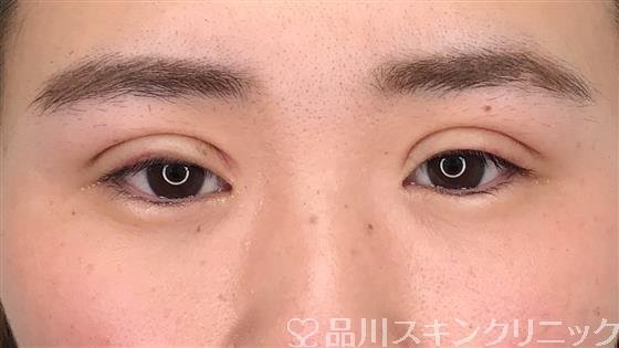 症例NO.57309のBEFORE写真